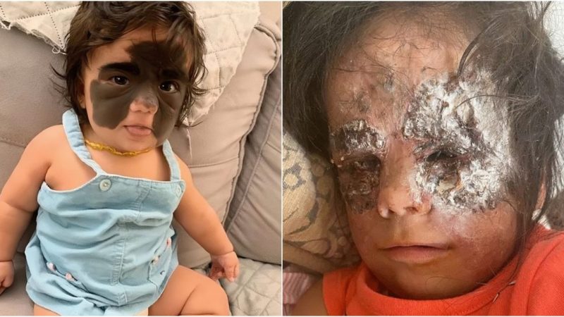 Girl, 2, with ‘Batman’ birth mark says ‘I’m a princess’ as it’s finally removed