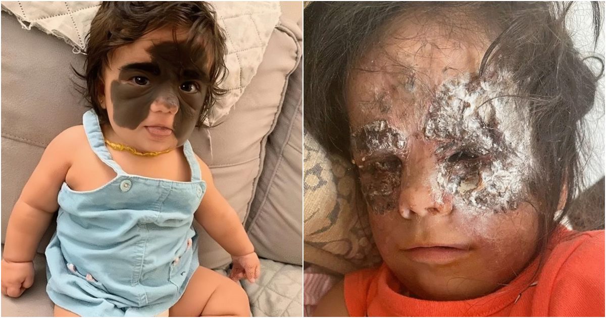 Girl, 2, with ‘Batman’ birth mark says ‘I’m a princess’ as it’s finally removed