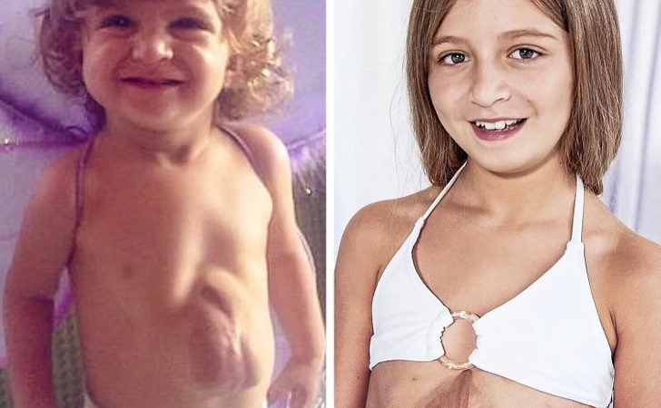 Meet a Miraculous Girl Who Was Born With a Heart Beating Outside the Chest