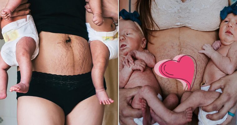 Pictures of moms demonstrating why they should be content with their stretch marks following childbirth