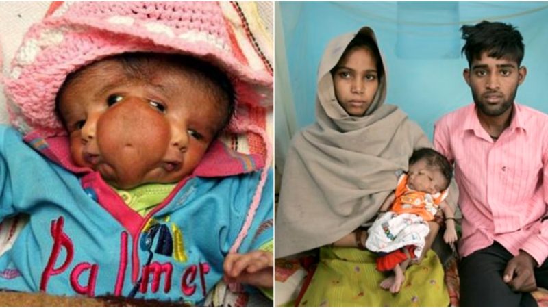 A Rare Phenomenon: Baby Born with Two Faces, a Normal Body