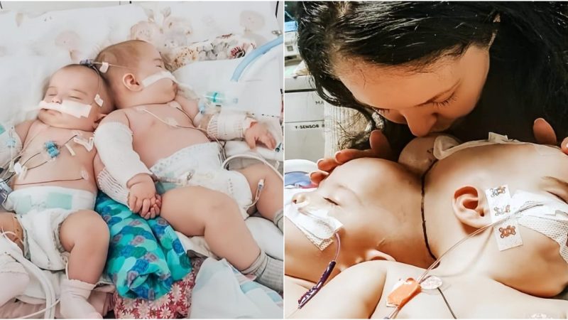 A Miraculous Journey: 9-Month-Old Twins Joined at the Head Successfully Separated, Defying a Profoundly Rare Anomaly