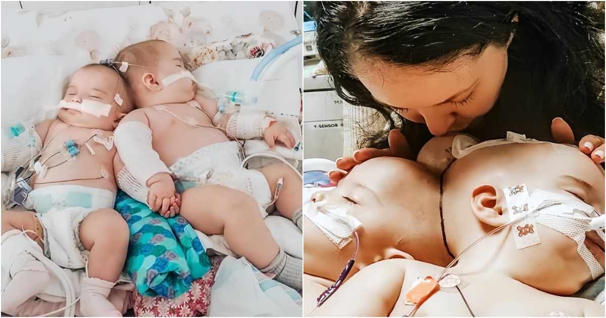 A Miraculous Journey: 9-Month-Old Twins Joined at the Head Successfully Separated, Defying a Profoundly Rare Anomaly
