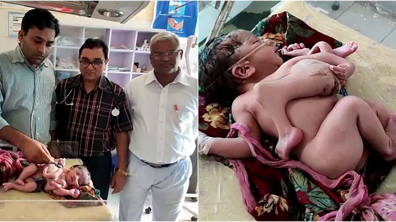 The Incredible Story of a Four-Legged and Three-Armed Indian Baby