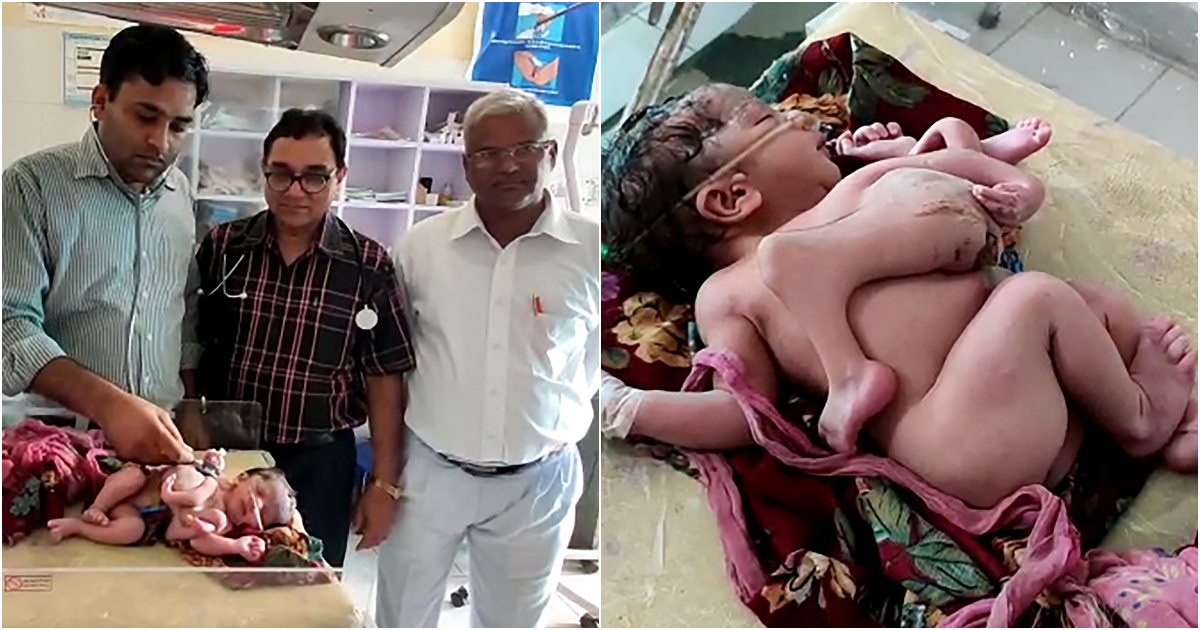 The Incredible Story of a Four-Legged and Three-Armed Indian Baby