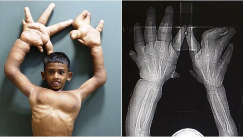 The Courageous Battle of a Boy with Giant Hands against Life’s Challenges