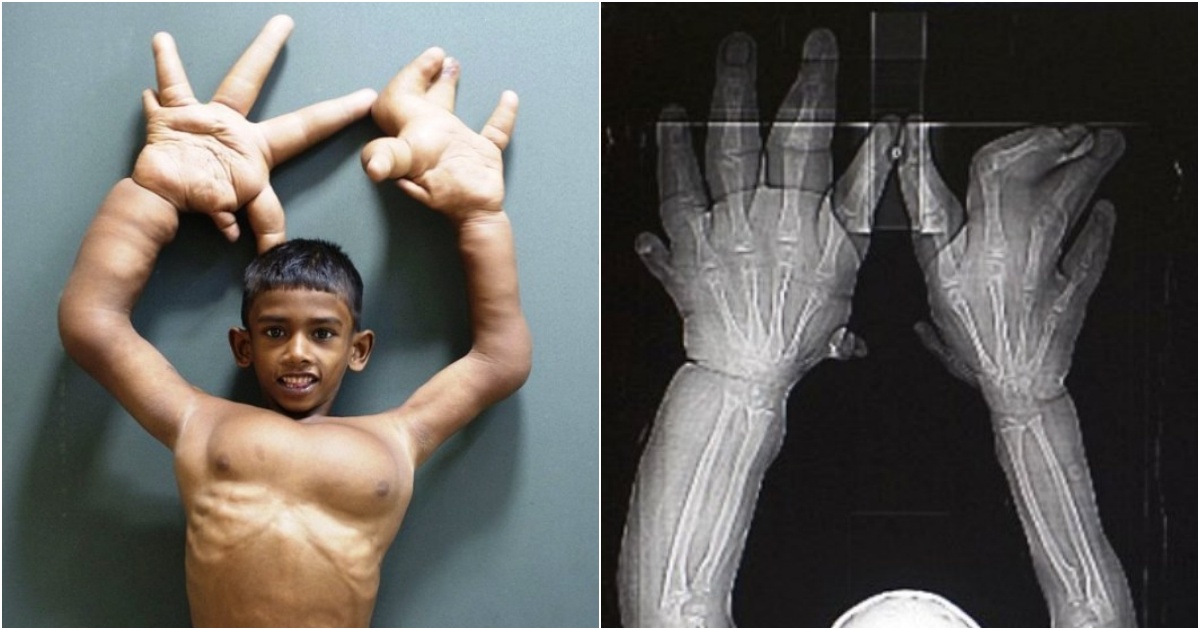 The Courageous Battle of a Boy with Giant Hands against Life’s Challenges