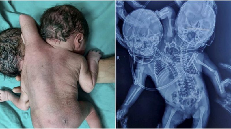 A Miracle of Uniqueness: Child Born with Two Hearts, Three Hands, and Two Heads Leaves Mother Stunned