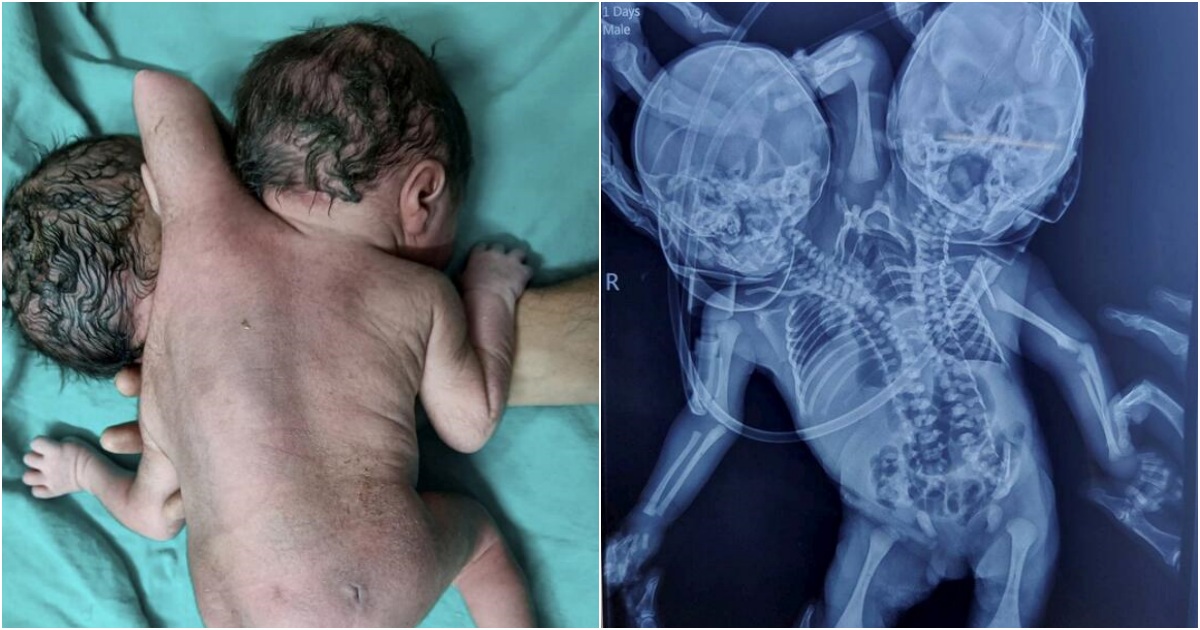 A Miracle of Uniqueness: Child Born with Two Hearts, Three Hands, and Two Heads Leaves Mother Stunned