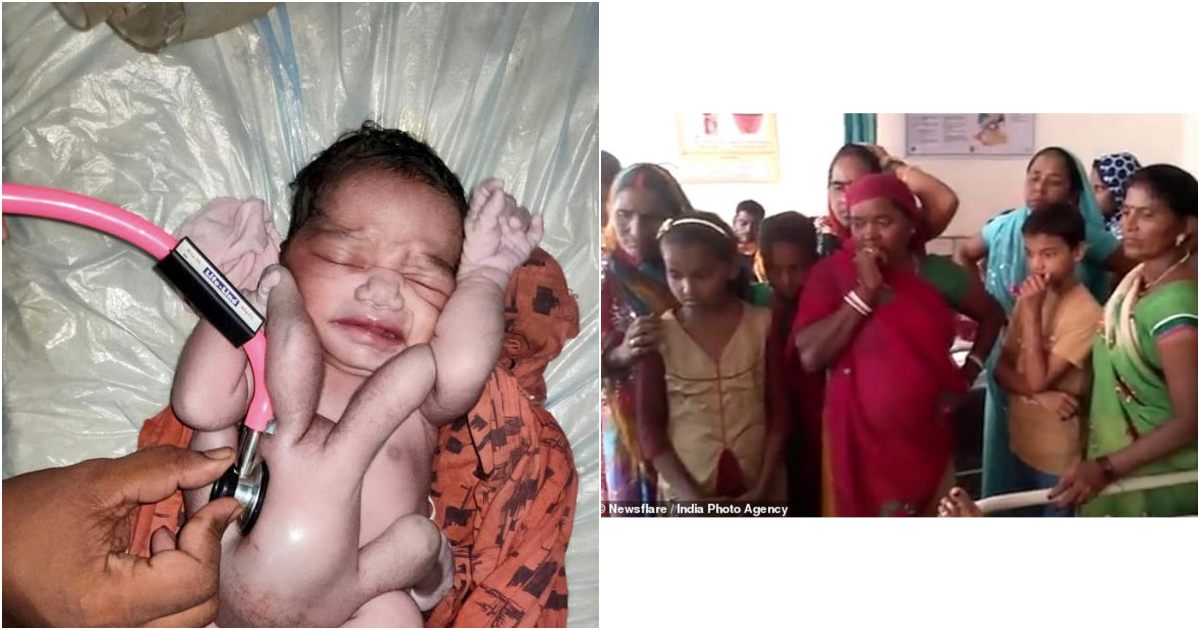Baby Born with Four Arms and Four Legs Shocks Locals: A Miraculous Phenomenon