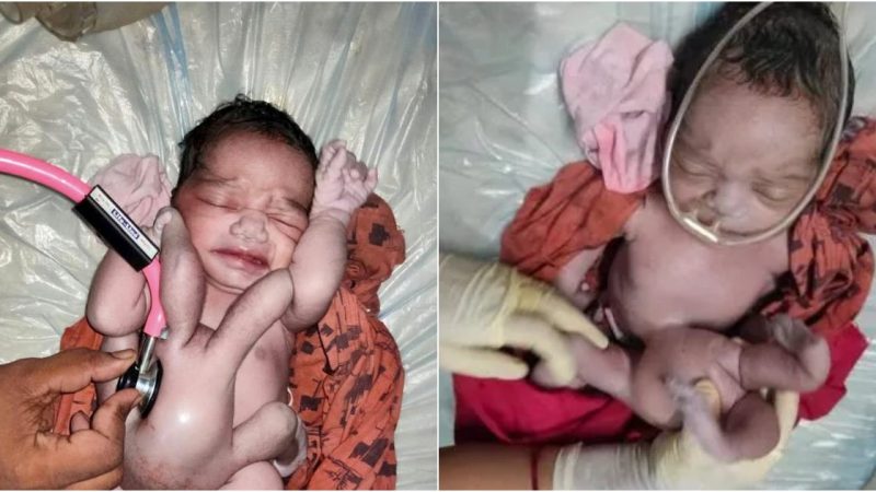 A Baby Is Born With Four Arms And Four Legs In India