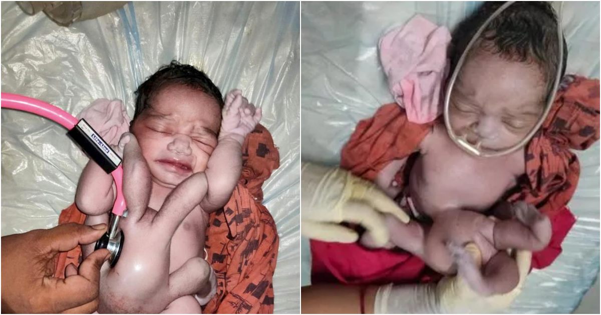 A Baby Is Born With Four Arms And Four Legs In India