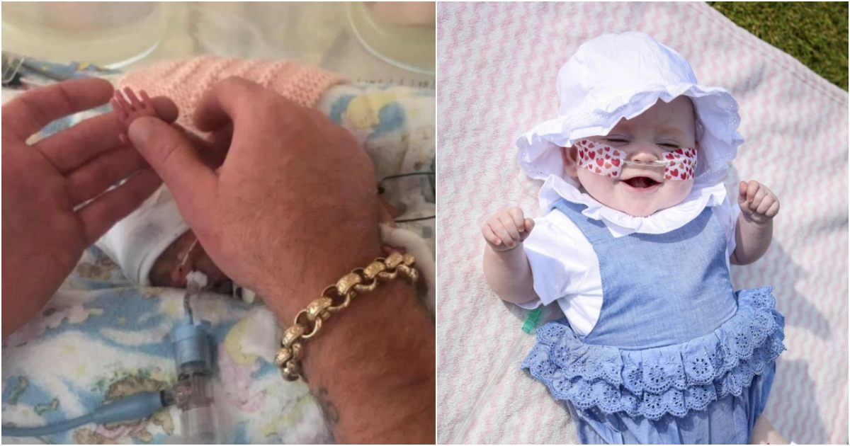 Miracle Baby: Tiny Newborn Born at 23 Weeks with Hands the Size of Her Dad’s Fingernail