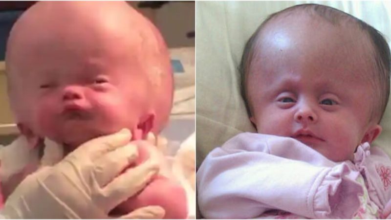 A Remarkable Journey Baby with Rare Cranial Condition Sparks Compassion and Hope