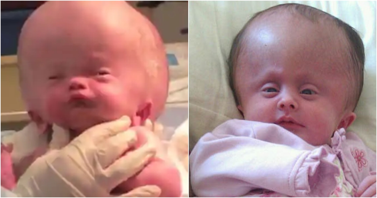 A Remarkable Journey Baby with Rare Cranial Condition Sparks Compassion and Hope