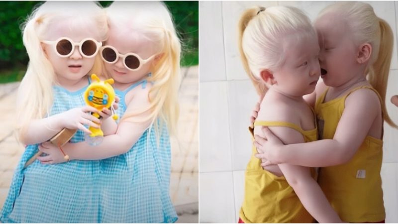 Mesmerizing Beauty Twin Babies Born with Snow-White Hair Capture Hearts with Their Unique Appearance!