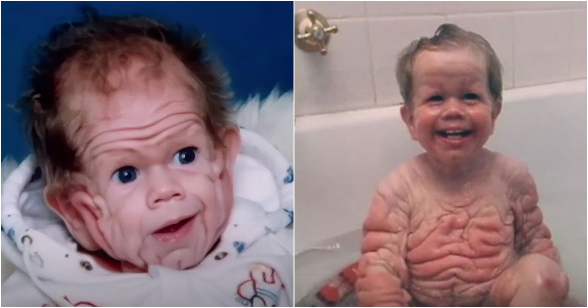 A Fascinating Tale The Baby Born with a Unique Skin Condition