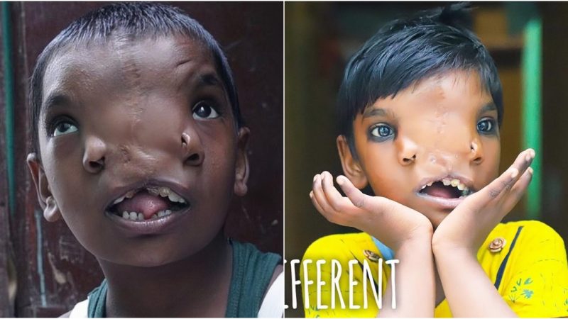 A Unique Blessing The Remarkable Features of a Baby Born with a Dual-Nostriled Face