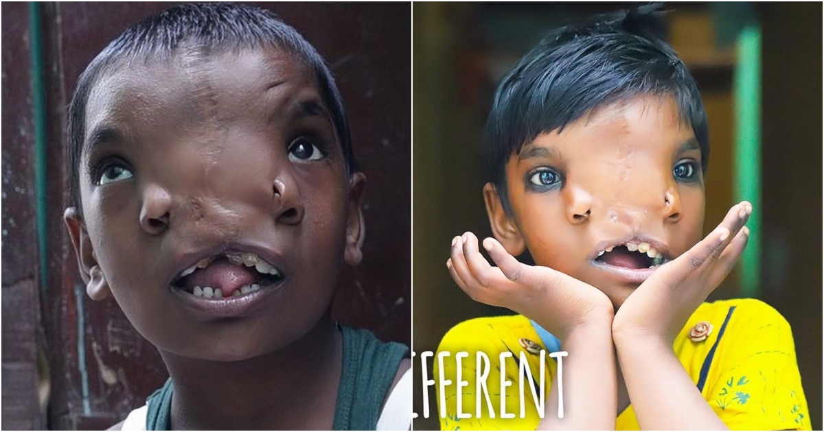A Unique Blessing The Remarkable Features of a Baby Born with a Dual-Nostriled Face