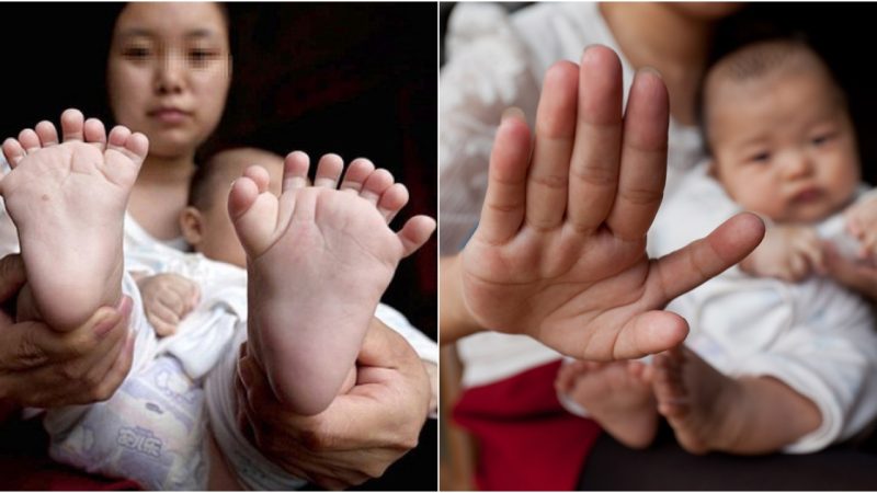 Unprecedented Birth in Hong Kong Baby with 31 Fingers and Toes Sets Guinness World Record (Video)