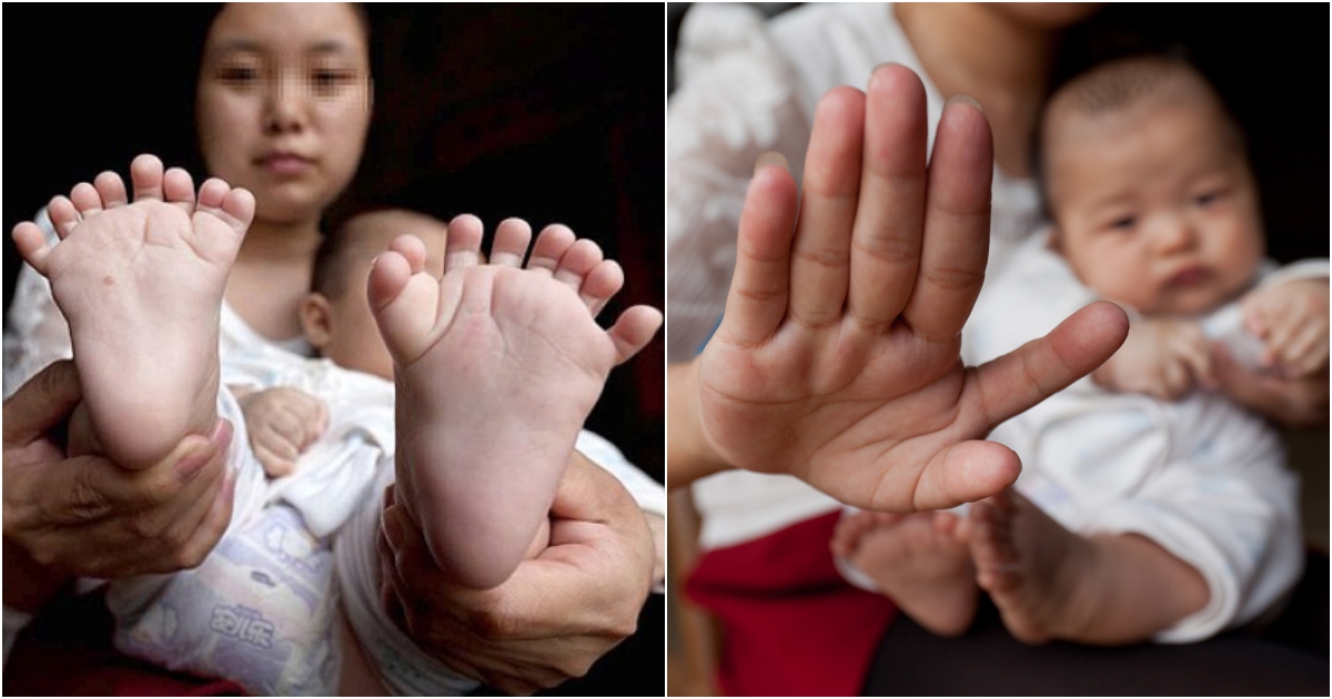 Unprecedented Birth in Hong Kong Baby with 31 Fingers and Toes Sets Guinness World Record (Video)