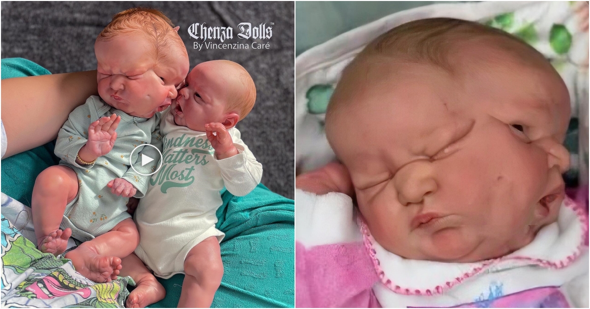 “Extraordinary newborn baby with remarkable conjoined faces captures online community with love and sympathy”