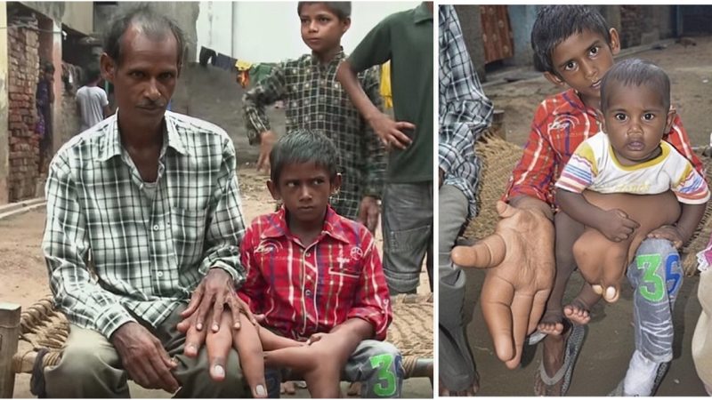 The Unforgettable Tale of the Boy with Enormous Hands: Embraced by a Supportive Community