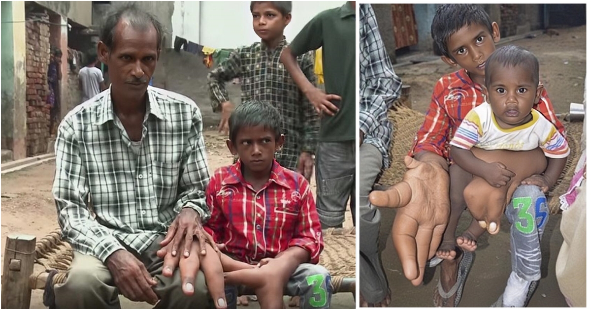 The Unforgettable Tale of the Boy with Enormous Hands: Embraced by a Supportive Community