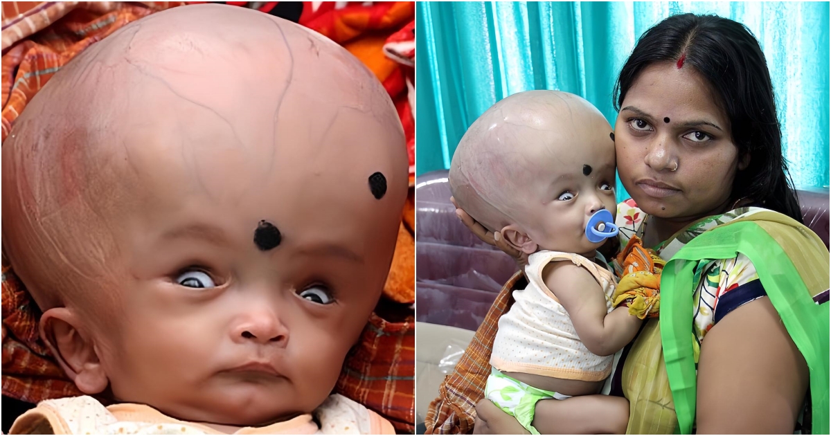 A 4-Month-Old Baby with a Head 3 Times Larger Than Normal Is Abandoned – Heart of the Community