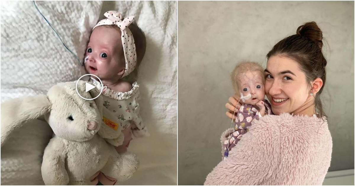 The Courageous Journey of Eline Léonie Defying Neonatal Progeria with a Radiant Smile!