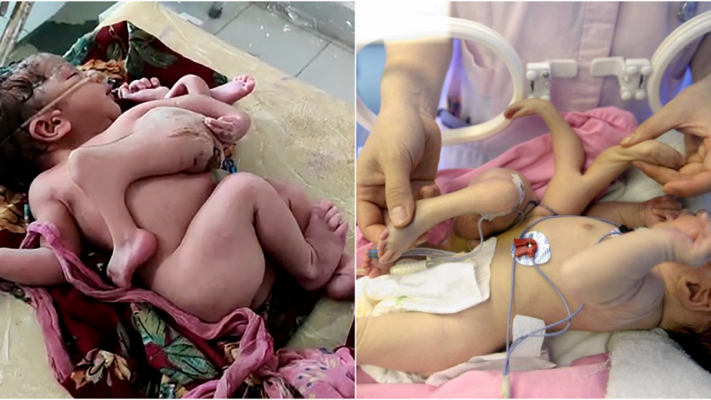 Unusual Birth: Baby Born with Four Legs and Three Arms in India Creates Sensation