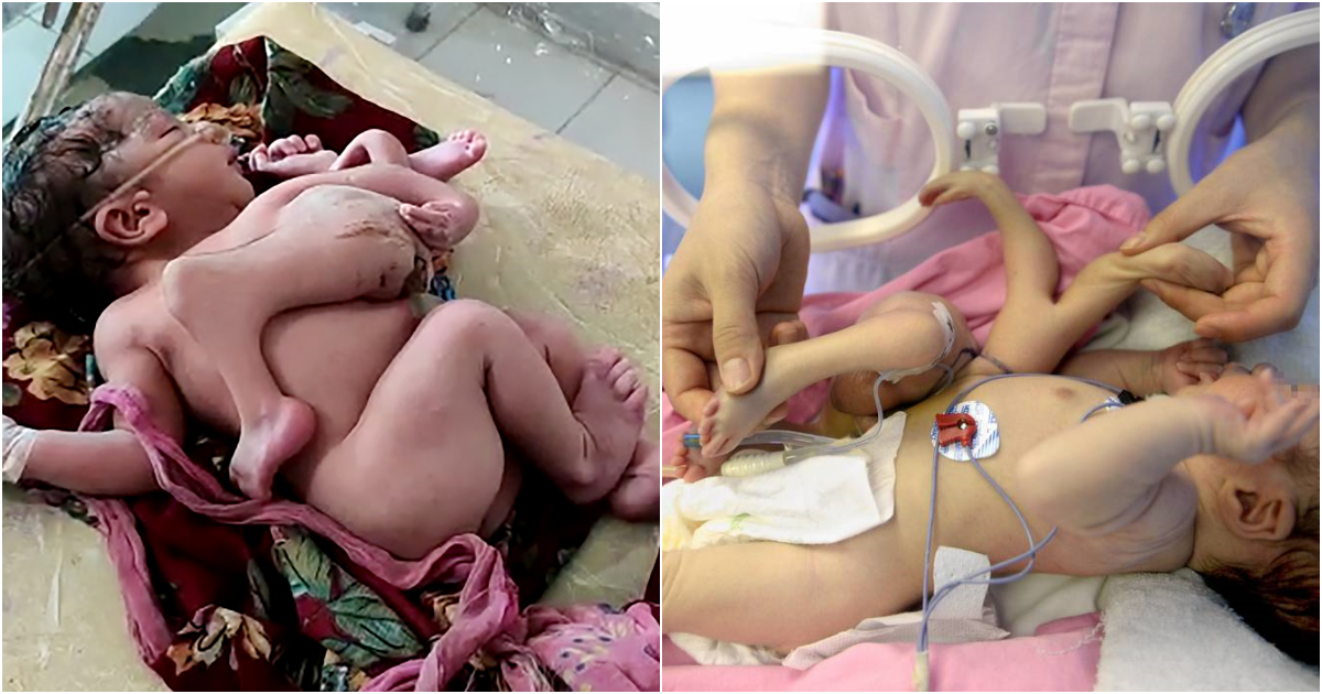 Unusual Birth: Baby Born with Four Legs and Three Arms in India Creates Sensation