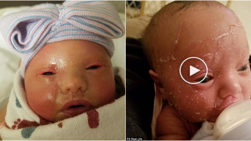 Mother Baths Baby with Bleach to Manage Rare Skin Condition, Calls for Understanding