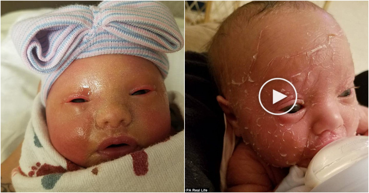 Mother Baths Baby with Bleach to Manage Rare Skin Condition, Calls for Understanding