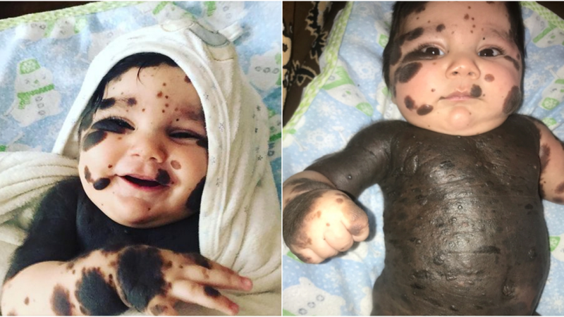 Boundless Love: Parents Embrace Son Born with 80% Birthmarks with Open Hearts