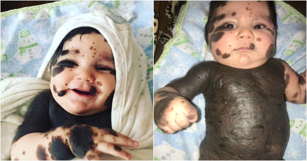 Boundless Love: Parents Embrace Son Born with 80% Birthmarks with Open Hearts