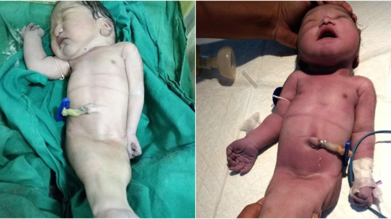 Rare Mermaid Syndrome: Newborn with Sirenomelia Survives for Four Hours in India