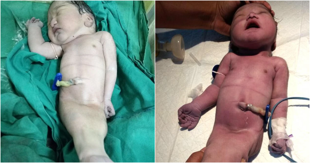 Rare Mermaid Syndrome: Newborn with Sirenomelia Survives for Four Hours in India