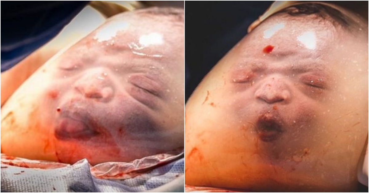 New Year’s Luck: Baby Born in Amniotic Sac with Adorable Expression Melts Everyone’s Hearts