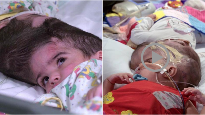 Rare Craniopagus Twins Successfully Separated After 50-Hour Surgery