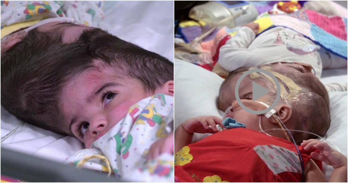 Rare Craniopagus Twins Successfully Separated After 50-Hour Surgery