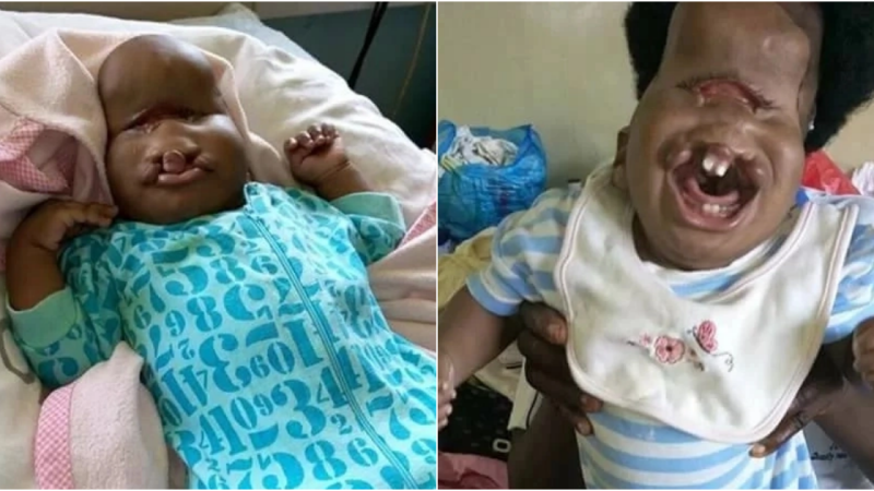 A Heartwarming Tale of Resilience: Abandoned Child with Facial Deformity Finds Love and Care in Kisumu Hospital