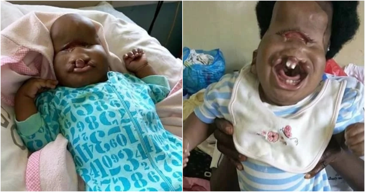 A Heartwarming Tale of Resilience: Abandoned Child with Facial Deformity Finds Love and Care in Kisumu Hospital