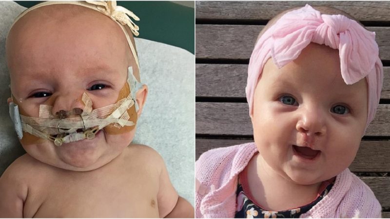 Joyful Baby Girl Laughs and Coos Happily Following Successful Cleft Palate Surgery