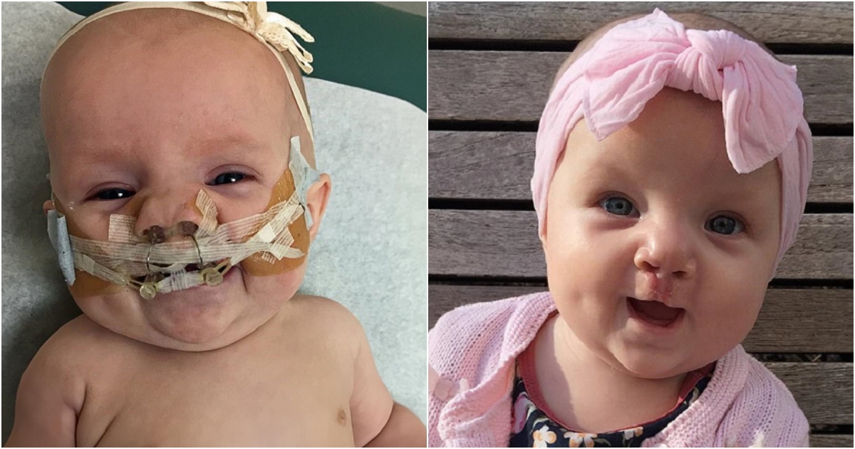 Joyful Baby Girl Laughs and Coos Happily Following Successful Cleft Palate Surgery