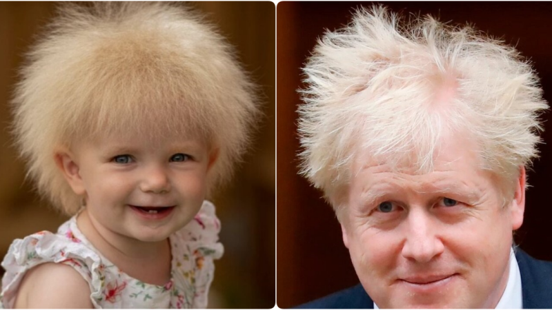 Unique Syndrome Gives Baby Layla Hair Resembling British Prime Minister Boris Johnson