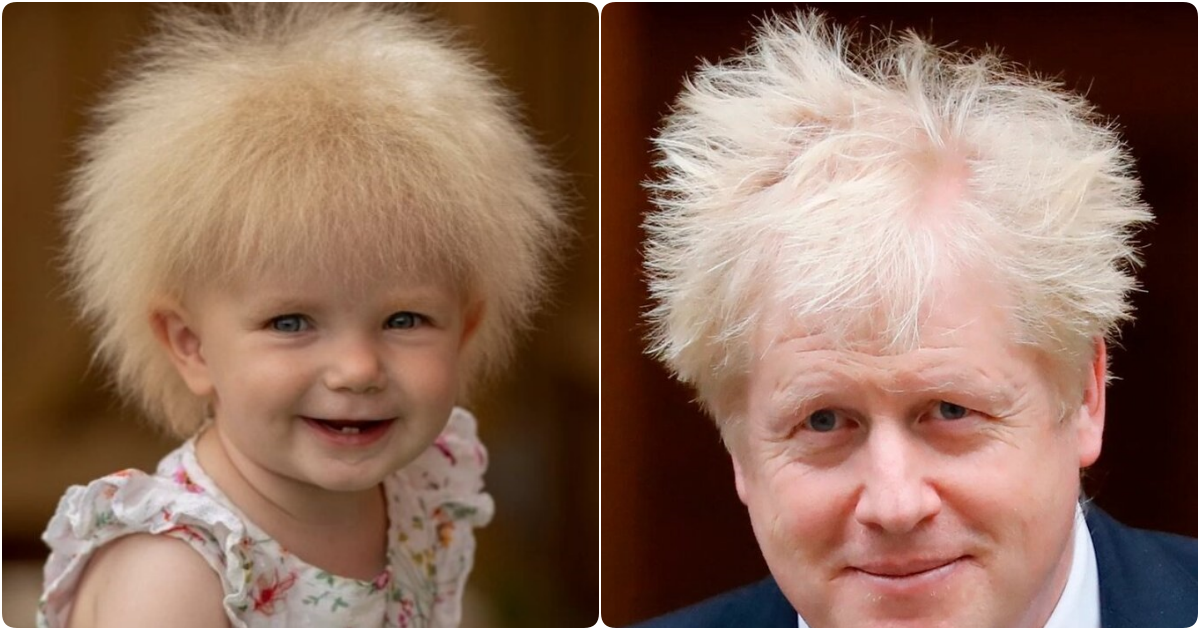 Unique Syndrome Gives Baby Layla Hair Resembling British Prime Minister Boris Johnson